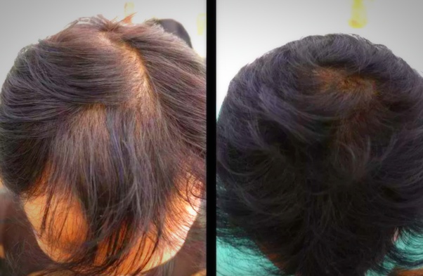 Leave All Doctors Surprised. Apply This Remedy And Grow Your Hair Like Crazy