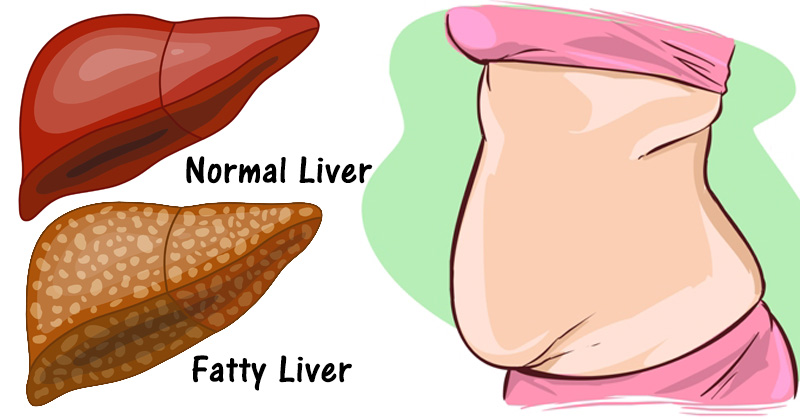 6 CLEAR WARNING SIGNS YOUR LIVER IS FULL OF TOXINS AND MAKING YOU FAT (HOW TO STOP IT)